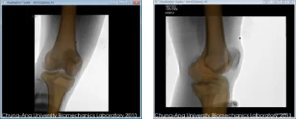 Fig.  3  Registration  between  model  silhouettes  and  bone  boundaries  in  two  directional  x-ray  images  using a MATLAB optimization routine 