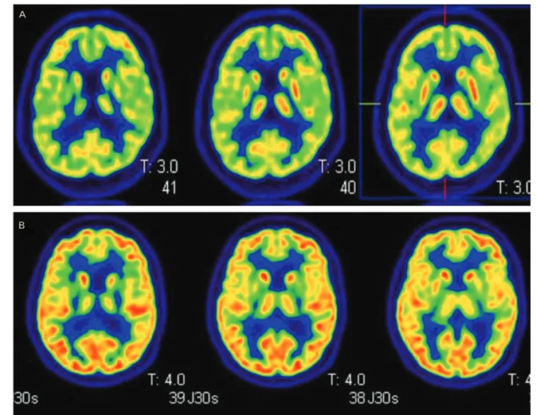 Figure 1: Representative images of [ 18 F]FDG PET results in patients with idiopathic Parkinson disease or multiple system atrophy-Parkinson type