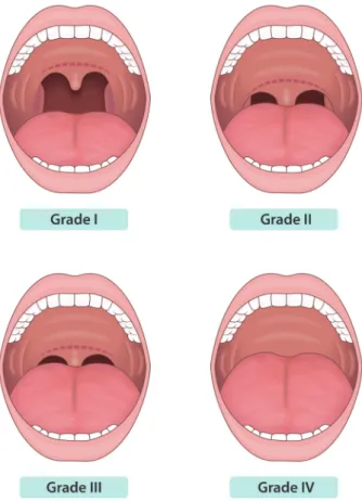 Fig. 1. The Mallampati classification. Grade I: soft palate, fauces, uvula, pil- pil-lars are visible