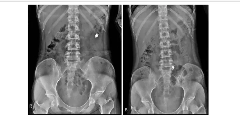 Figure 1. Serial abdominal radiographs after capsule endoscopy. (A) Radiograph 2 weeks after capsule endoscopy shows capsule retention in the left upper quadrant