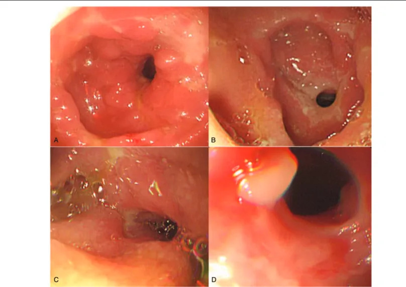 Figure 2. Single-balloon enteroscopy images show multiple areas of luminal narrowing and mucosal deformity with a cobblestone appearance.
