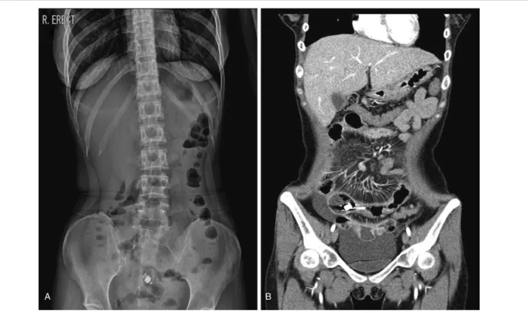 Figure 4. Radiograph 12 months after capsule endoscopy shows disap- disap-pearance of the capsule.