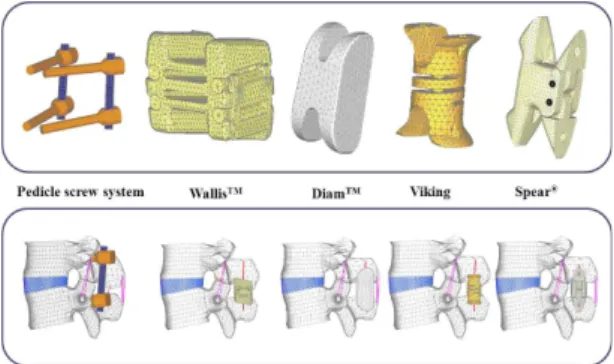 Fig. 1 Developed FE models of the intact L3-L4  functional spinal unit and integrations of a pedicle  screw system and four kinds of IPSs into L3-L4  functional spinal unit