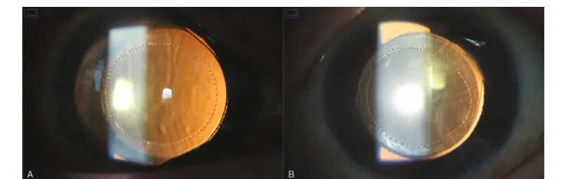 Figure 1. Examples of measurements of circularity and capsulotomy area by ImageJ software