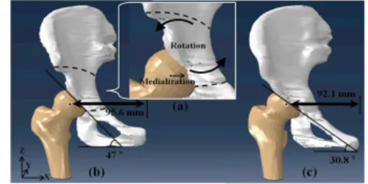 Fig. 1    Frontal view of a developed patient-specific 3-D  FE model of right hip and showed anatomical  parameters (hip inclination angle in normal line,  DBSPFH in bold  line,  periacetabular osteoto-  mies in broken line)