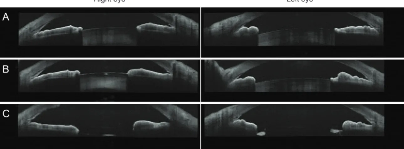 Fig. 1. Anterior-segment optical coherence tomography image of the patient. (A) Before laser iridotmy, acute angle-closure glaucoma  showed bilateral occluded angle