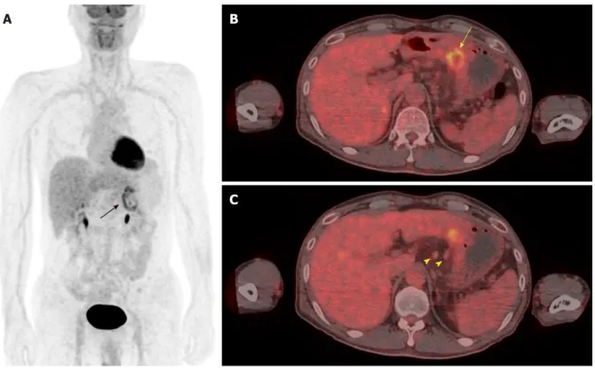 Figure 2  Contrast-enhanced abdominal computed tomography images. A: A huge ulcer lesion with diffuse wall thickening was detected in the posterior wall of the lower body of the stomach (yellow arrow head); B: Multiple enlarged left gastric lymph nodes wer
