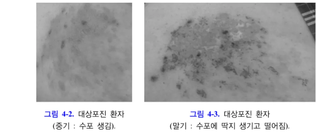 그림 4-2.  대상포진 환자 (중기 :  수포 생김).     그림 4-3.  대상포진 환자 (말기 :  수포에 딱지 생기고 떨어짐).       문제는 이런 전형적인 경과를 지나가는 환자가 50-60% 정도이다