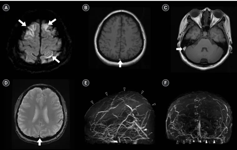 Fig. 2. Cerebral venous thrombosis. (A) Diffusion-weighted magnetic resonance (MR) imaging (MRI) revealing acute cerebral infarctions  (arrows) at both frontal lobes