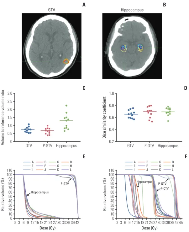 Fig. 3.  Gross tumor volume (GTV) (A) and hippocampus delineation (B) in a computed tomography image for patient C.