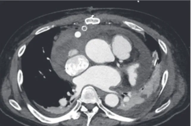 Fig. 1. Computed Tomography shows large amount of  pericardial effusion with both pleural effusion.