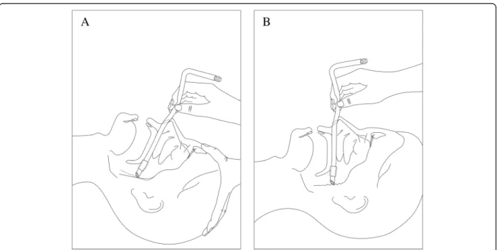 Fig. 1 Schematic diagram of two methods with or without neck extension for tube advancement from the nasal cavity into the oropharynx