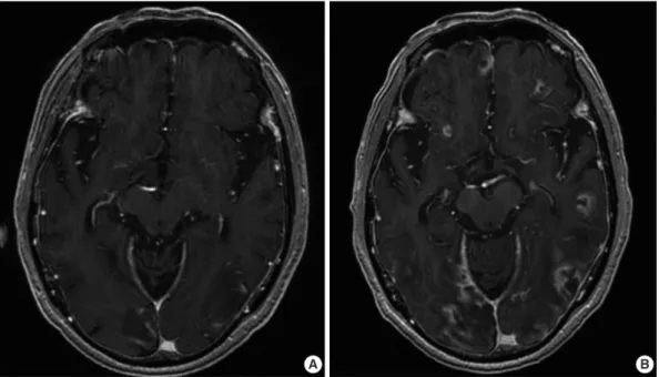 Fig. 1. (A) Initial magnetic resonance imaging (MRI) showing multiple ring-enhancing nodules in the cortical and subcortical areas of both ce- ce-rebral hemispheres