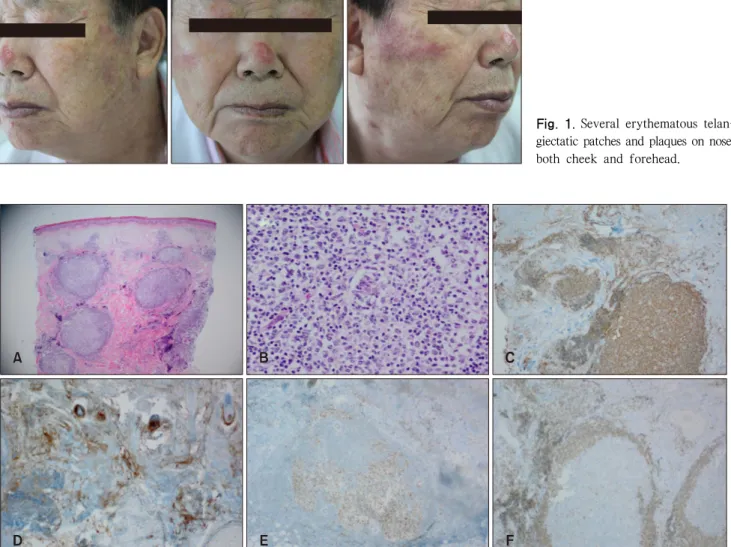Fig. 1.  Several erythematous telan- telan-giectatic patches and plaques on nose, both cheek and forehead.
