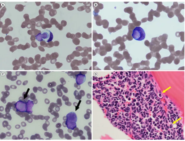 Fig. 1. Cellular cannibalism on peripheral blood (PB) smear and bone marrow (BM) biopsy section
