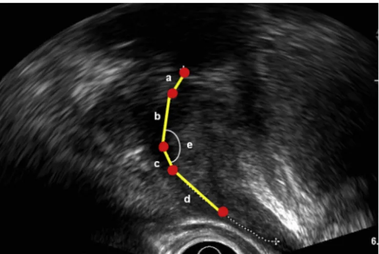 Fig. 1. Ultrasonographic measurements of prostatic urethral length (a þ b þ c þ d), transitional zone urethral length (a þ b þ c), and prostatic urethral angle (e) in a midsagittal image of a transrectal ultrasound.