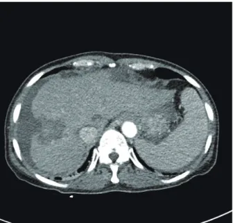 Figure 1. Dynamic CT during arterial phase showing an ill-defined, irregu- irregu-larly shaped liver abscess in the right anterior, superior segment of the liver 