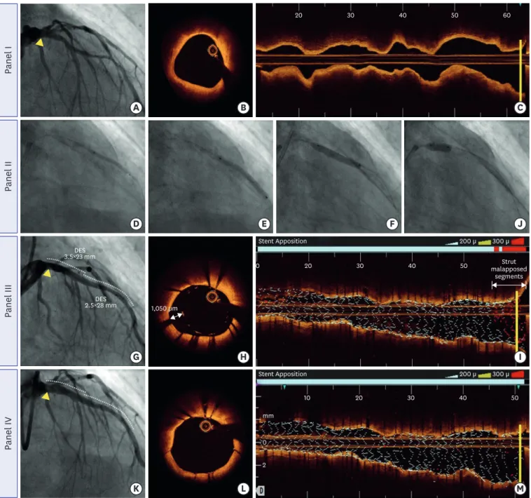 Figure 5. A representative case demonstrating a stent malapposition viewed by OCT. Preinterventional angiography and OCT images (panel I, A-C)