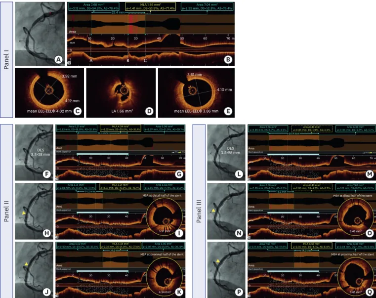 Figure 2. A representative case of an OCT-guided PCI (stent sizing and post-stent optimization)