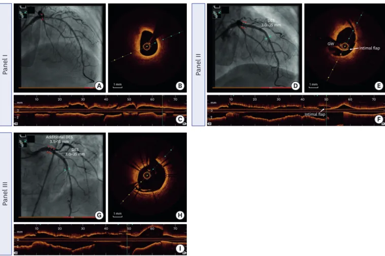Figure 4. A representative case of an OCT-angiography coregistration. Preinterventional OCT-angiography coregistration (panel I, A-C)