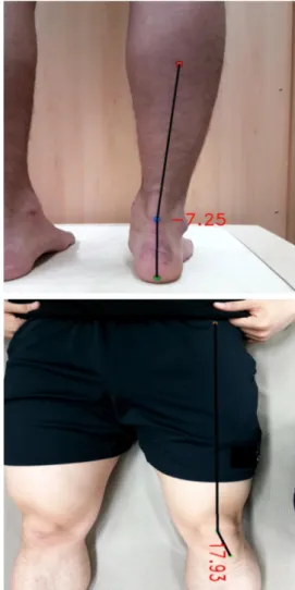 Figure 1.  Static lower extremity alignment measurements on alignment application 
