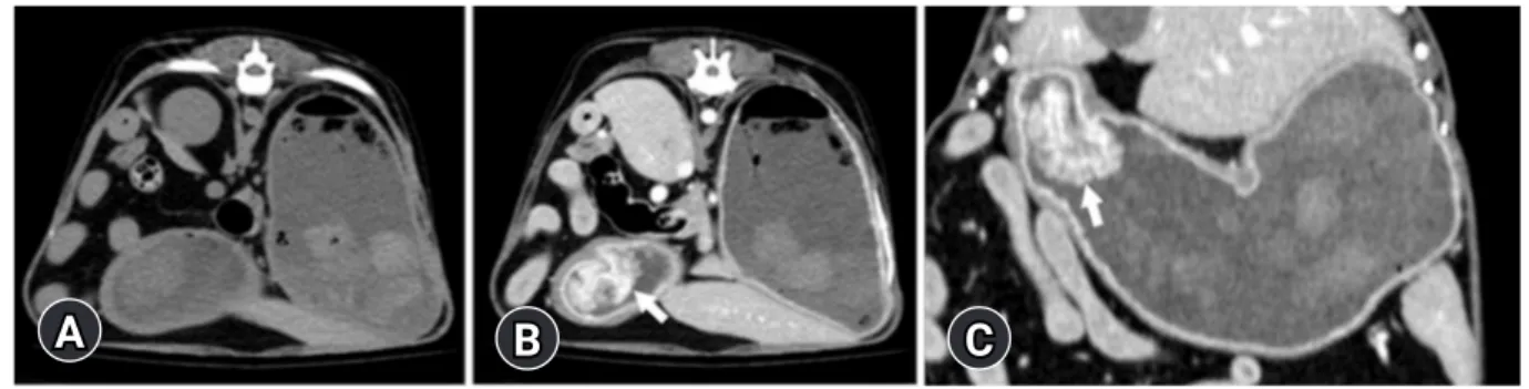 Fig. 3.  Histopathological section of the pyloric mass. Cystic hyperplasia of the gastric mucosal epithelium, with thickened gastric  muscularis and broad edematous lesions, and infiltration of chronic-active inflammatory cells are identified