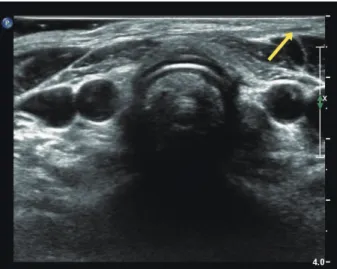 Fig. 1. Early ultrasound examination showed linear and hypoecho- hypoecho-ic lesion (arrow) assumed as foreign body between skin layer and  strap muscle.