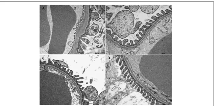 FIGURE 3 | Effects of pioglitazone, dapagliflozin and combination on glomerulus morphology by electron microscope