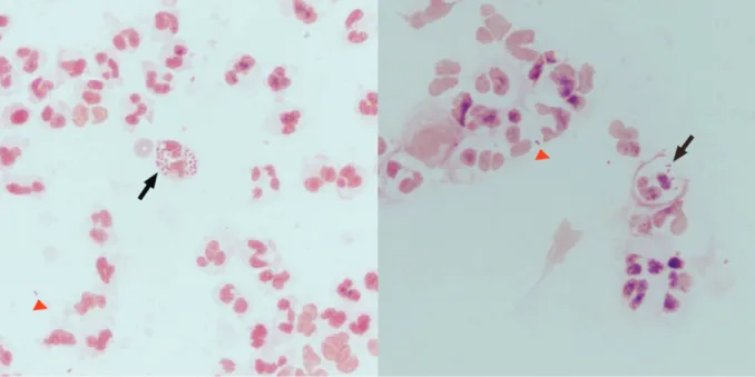 Fig. 2. Gram staining of the yellow-white purulent ocular discharge smear showed many polymorphonuclear cells  with intra- (arrow) and extracelluar (arrow head) gram negative reniform diplococcic (x1000, oil immersion).