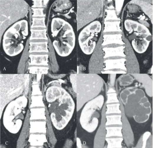 Fig. 1. Hydronephrosis grade in CT (coronal view). (A) Grade 0. (B) Grade 1. (C) Grade 2