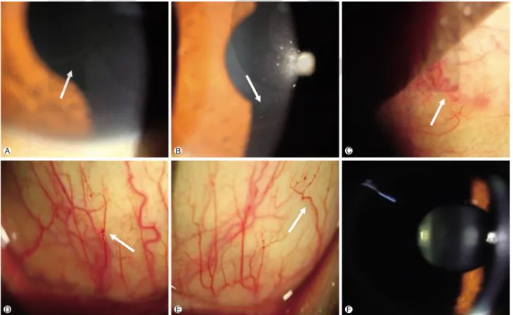 Fig. 2. Photographs of a patient with de novo Fabry disease. Cornea verticillata (arrow) show whorl-like pattern of white, brown corneal opacity in the right eye (A) and left eye (B)