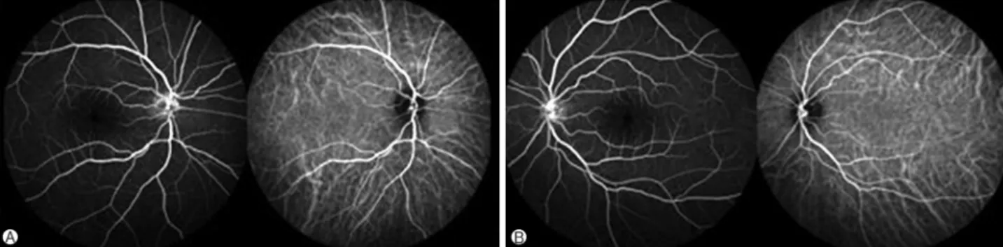Fig. 3. Photographs of fluorescein angiography and indocyanine green angiography (A, right eye; B, left eye) taken about 2 minutes after the injection show no vascular abnormality.