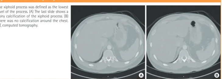 Fig. 1. Definition of the xiphoid process on CT The xiphoid process was defined as the lowest  level of the process