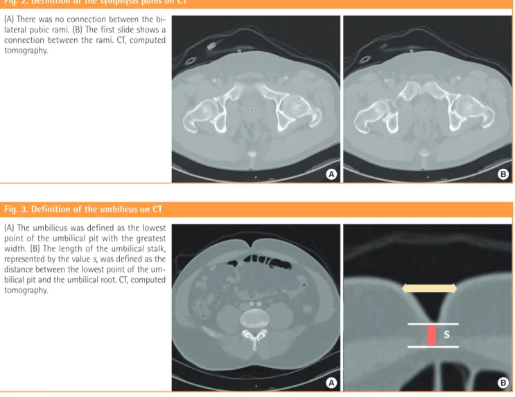 Fig. 3. Definition of the umbilicus on CT (A) The umbilicus was defined as the lowest  point of the umbilical pit with the greatest  width