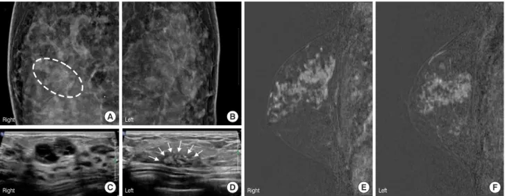 Figure 2. Low power microscopic-findings of the right (A, H&amp;E stain, ×40) and left (C, ×100) breast masses showed atypical ductal proliferation with cribriform,  solid, papillary, and micropapillary patterns