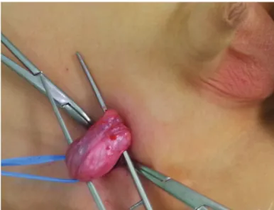 Figure 2.  Orchiopexy  was  done  by  right  inguinal