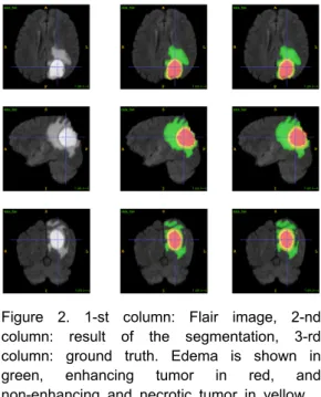 Figure 2. 1-st column: Flair image, 2-nd  column: result of the segmentation, 3-rd  column: ground truth