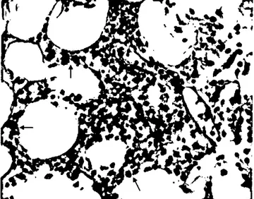 Figure 3. Multiple ovoid granular basophilic calcareous