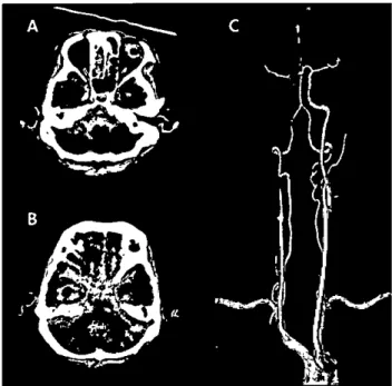 Figure 3. Brain CT angiogram at the 5th day after a<lm 뼈 sion.
