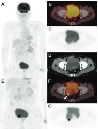 Figure 2. Follow-up  FDG  PET/CT  was  performed  on  9