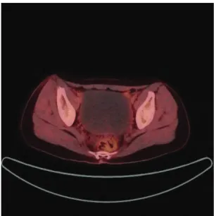 Figure 4.  Enhanced  pelvis  Magnetic  Resonance  scan