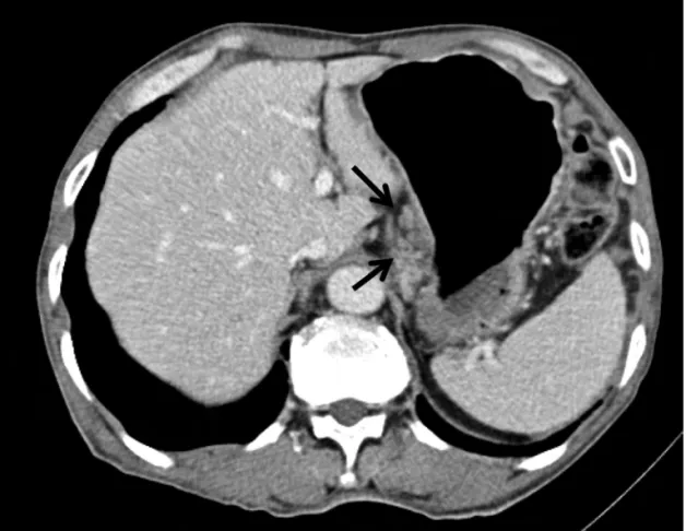 Figure  1.  The  abdominal  computed  tomography  showed  diffuse  gastric  wall  thickening  with