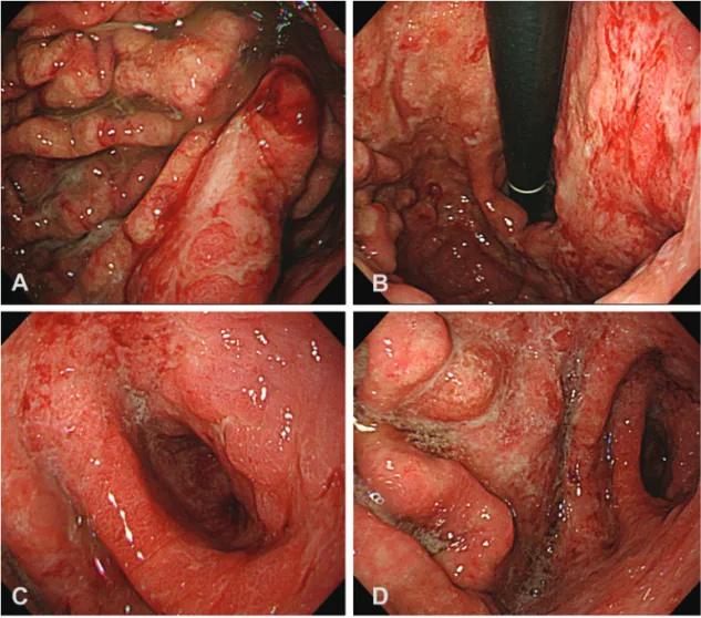 Figure 2. Gastroscopy showed multiple ulcers and erosions with diffuse fold thickening (A)