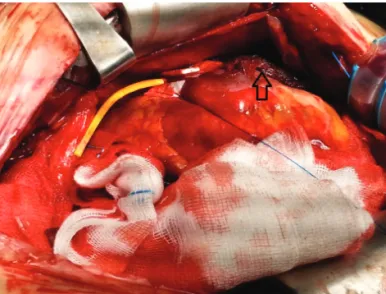Figure 2A.  Intraoperative  finding.  (A)  Protruding