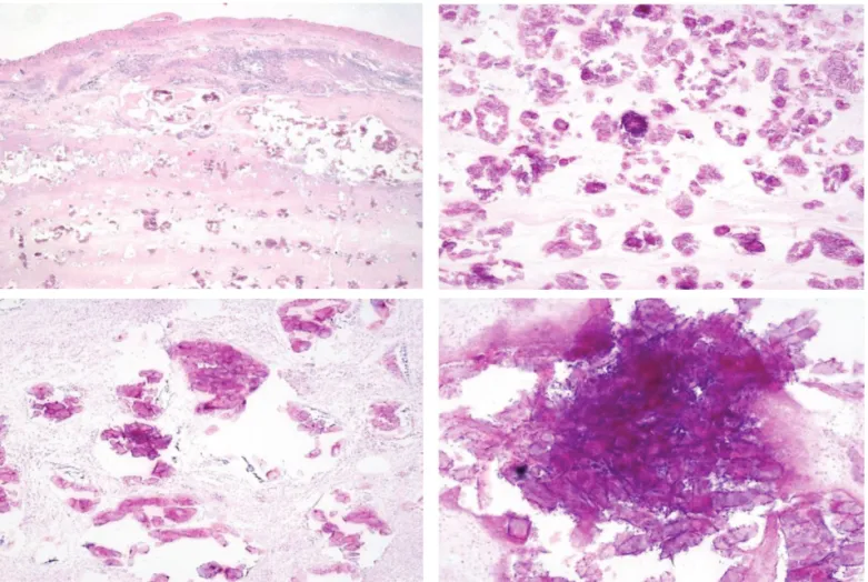 Figure 3. Microscopic finding of bladder calcifying lesion  The lesion is covered with a shaggy coat of fibrin mixed with