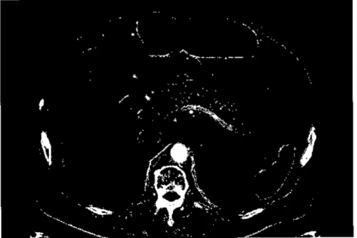 Figure 1. Abdominal computed tomography scan shows minute fatty infiltrations 밍 ld hazzmess in pancreas