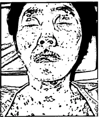 Figure 1. Scattered purpuric macules ‘ multifocal erosions ‘
