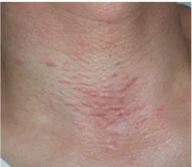 Figure 1.  Clustered  multiple  minute  folliculocentric