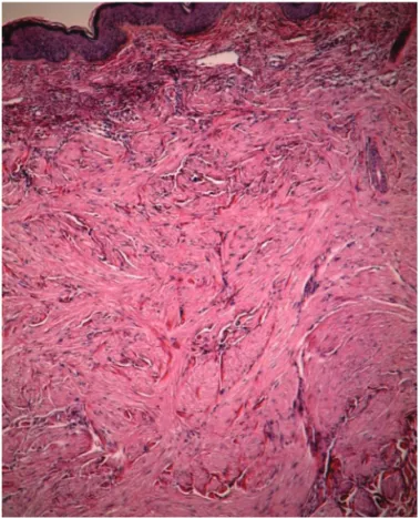 Figure 2.  (B)  Dermal  tumor  composed  of  compact
