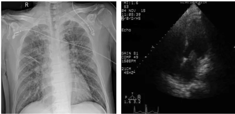 Figure 3. Chest X-ray (anterior-posterior) Figure 4. Echocardiogram (apical 4 chamber view)